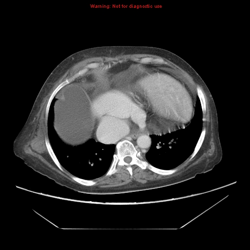 File:Abdominal wall hematoma (Radiopaedia 9427-10112 Axial C+ portal venous phase 12).jpg