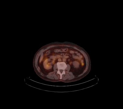 File:Abdominal wall metastasis from colorectal carcinoma (Radiopaedia 31016-31719 C 65).jpg