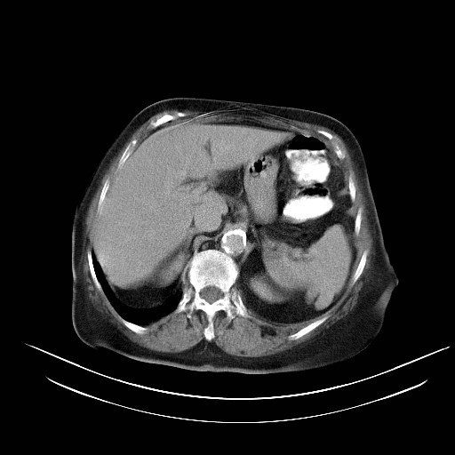 File:Abdominal wall recurrence after colorectal resection for cancer (Radiopaedia 23444-23523 Axial C+ portal venous phase 5).jpg