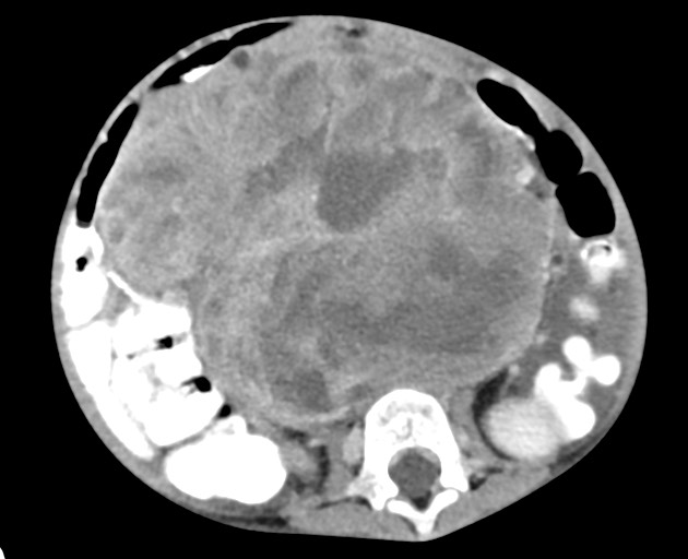 Abdominopelvic rhabdomyosarcoma (Radiopaedia 78356-90984 Axial C+ portal venous phase 99).jpg