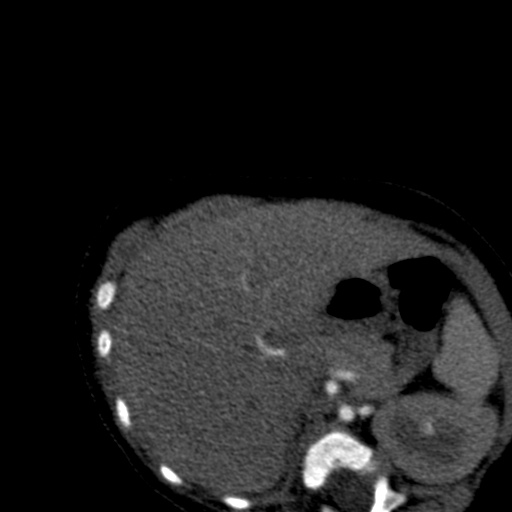 File:Aberrant left pulmonary artery (pulmonary sling) (Radiopaedia 42323-45435 Axial C+ CTPA 52).jpg