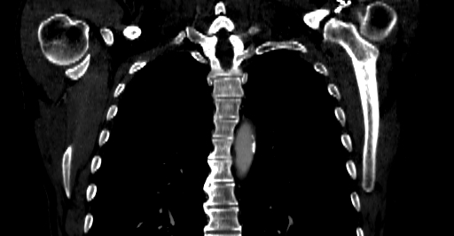 Accesory rib joint (Radiopaedia 71987-82452 Coronal bone window 29).jpg