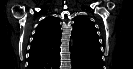 File:Accesory rib joint (Radiopaedia 71987-82452 Coronal bone window 35).jpg