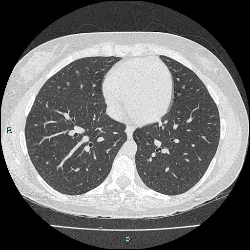 Accidental foreign body aspiration (seamstress needle) (Radiopaedia 77740-89983 Axial lung window 43).jpg