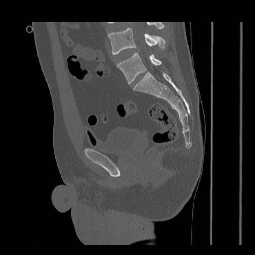 Acetabular and ilial fractures (Radiopaedia 59084-66378 Sagittal bone window 54).jpg