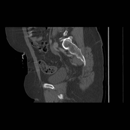 File:Acetabular fracture (Radiopaedia 13193-13212 Sagittal bone window 37).jpg