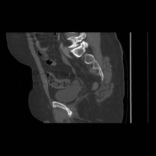 File:Acetabular fracture (Radiopaedia 13193-13212 Sagittal bone window 39).jpg
