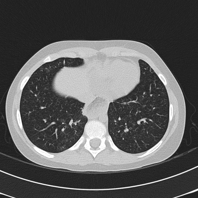 Achalasia (Radiopaedia 14946-14878 Axial lung window 60).jpg
