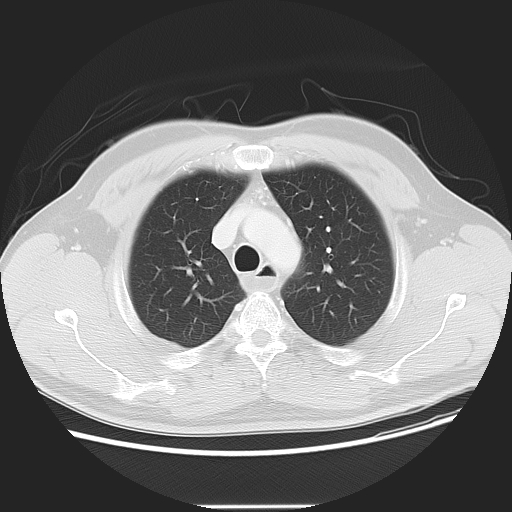 Achalasia (Radiopaedia 8831-9629 Axial lung window 19).jpg
