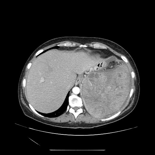 File:Acinar cell carcinoma of the pancreas (Radiopaedia 75442-86669 Axial C+ portal venous phase 20).jpg
