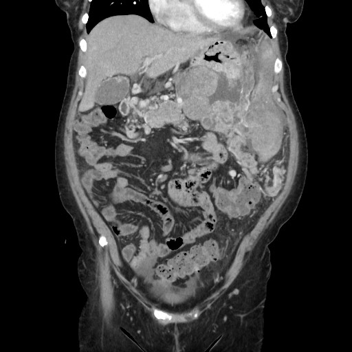 Acinar cell carcinoma of the pancreas (Radiopaedia 75442-86669 Coronal C+ portal venous phase 41).jpg