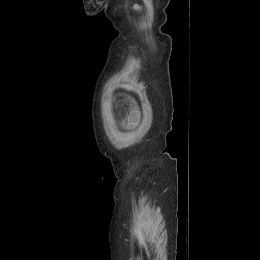 Acinar cell carcinoma of the pancreas (Radiopaedia 75442-86669 Sagittal C+ portal venous phase 25).jpg