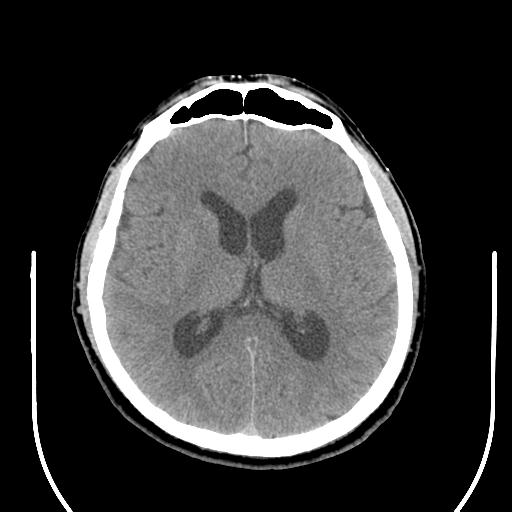 File:Acoustic schwannoma (Radiopaedia 29488-29982 AXIAL THICK non-contrast 27).jpg