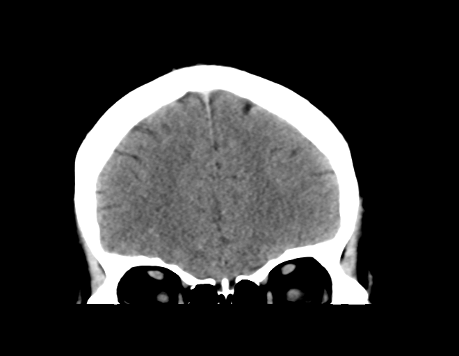 File:Acoustic schwannoma (Radiopaedia 33045-34065 Coronal non-contrast 13).png