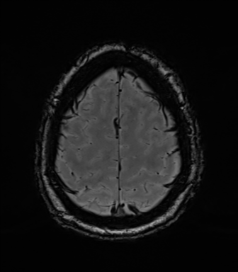 Acoustic schwannoma (Radiopaedia 50846-56358 Axial SWI 80).png