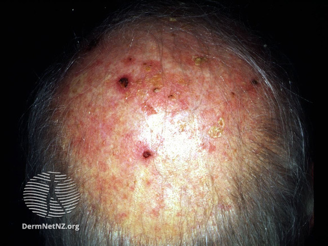 File:Actinic keratoses (DermNet NZ lesions-sk1).jpg