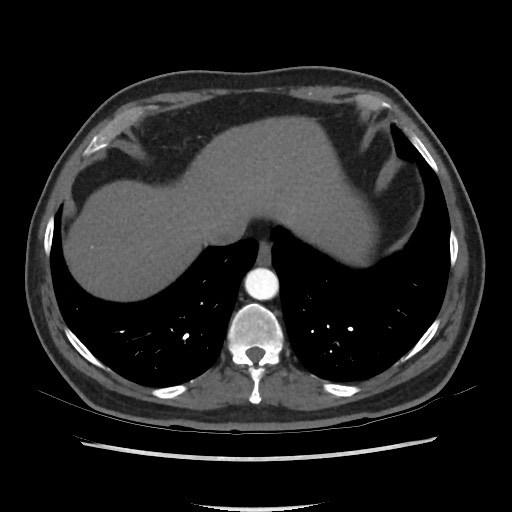 Active colonic bleed on CT (Radiopaedia 49765-55025 Axial C+ arterial phase 11).jpg