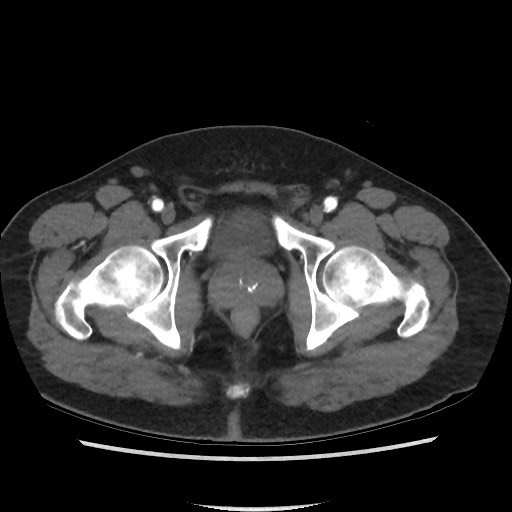 Active colonic bleed on CT (Radiopaedia 49765-55025 Axial C+ arterial phase 81).jpg