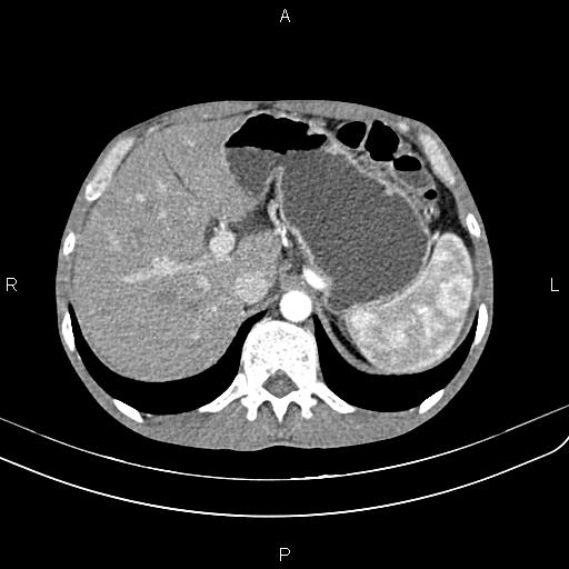 Active crohn disease (Radiopaedia 87133-103397 Axial C+ arterial phase 25).jpg