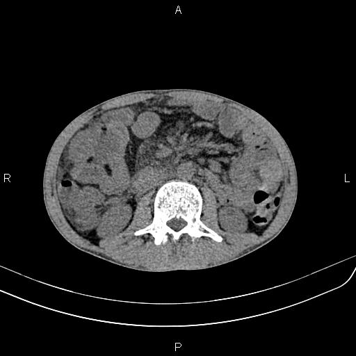 File:Active crohn disease (Radiopaedia 87133-103397 Axial non-contrast 49).jpg
