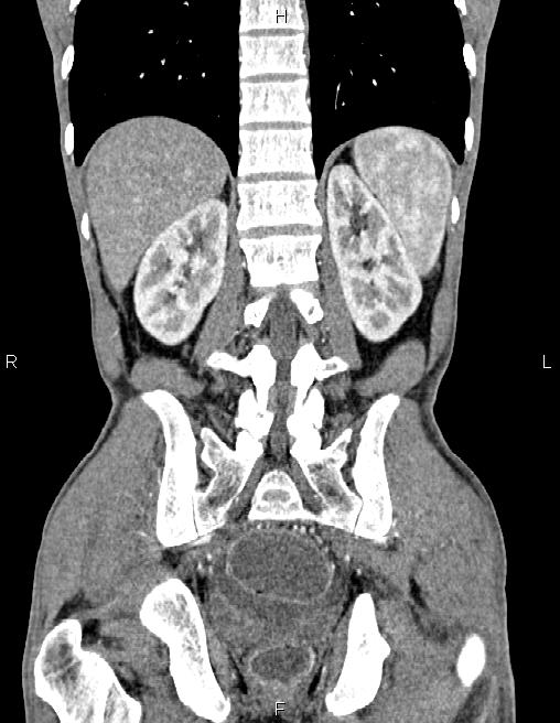 Active crohn disease (Radiopaedia 87133-103397 Coronal C+ arterial phase 48).jpg