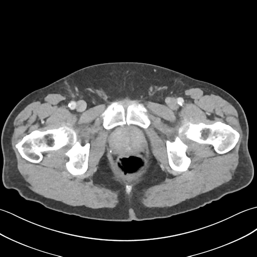 File:Active diverticular hemorrhage (Radiopaedia 39415-41725 Axial C+ portal venous phase 72).png