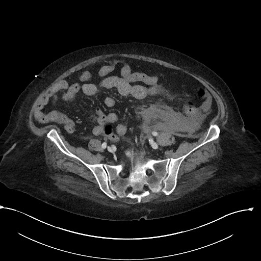 File:Active renal extravasation with large subcapsular and retroperitoneal hemorrhage (Radiopaedia 60975-68796 Axial 260).jpg