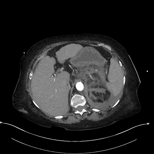 Active renal extravasation with large subcapsular and retroperitoneal hemorrhage (Radiopaedia 60975-68796 Axial C+ arterial phase 49).jpg