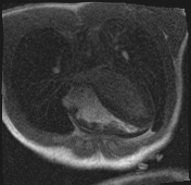 File:Active right ventricular cardiac sarcoidosis (Radiopaedia 55596-62100 Axial Dynamic perfusion scan MOCO 35).jpg