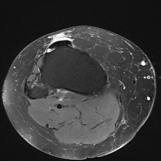File:Acute-on-chronic transient lateral patellar dislocation with trochlear dysplasia (Radiopaedia 84099-99349 Axial PD fat sat 31).jpg