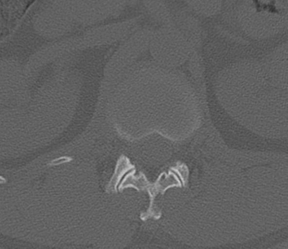File:Acute L1 burst compression fracture (Radiopaedia 34430-35755 Axial bone window 17).png