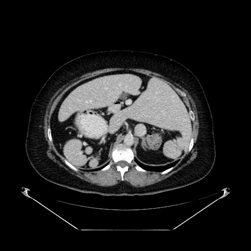 File:Acute appendicitis, heterotaxy syndrome (Radiopaedia 66884-76202 Axial 77).jpg