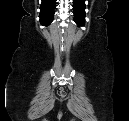 Acute appendicitis, heterotaxy syndrome (Radiopaedia 66884-76202 Coronal C+ portal venous phase 110).jpg