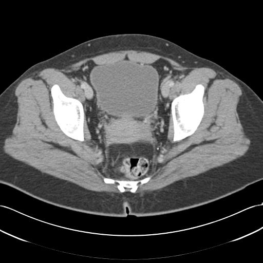 Acute appendicitis (Radiopaedia 30297-30934 Axial C+ portal venous phase 73).jpg
