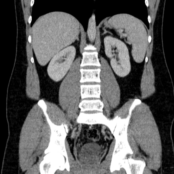 Acute appendicitis (Radiopaedia 38255-40270 Coronal C+ portal venous phase 56).jpg