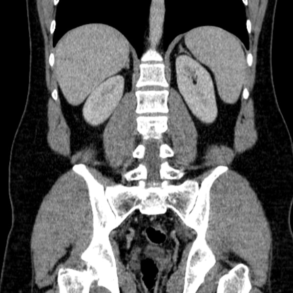 Acute appendicitis (Radiopaedia 38255-40270 Coronal C+ portal venous phase 60).jpg