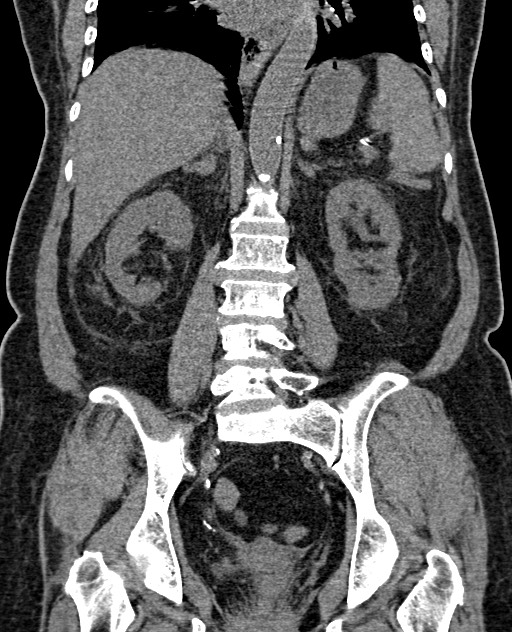 Acute appendicitis (Radiopaedia 58627-65818 Coronal non-contrast 47).jpg