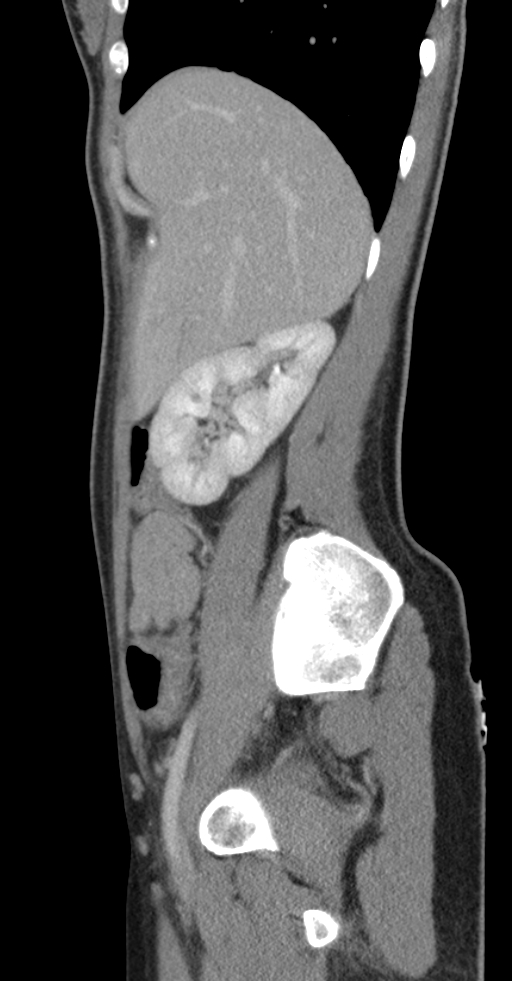 Acute appendicitis (Radiopaedia 62608-70901 Sagittal C+ portal venous phase 44).jpg