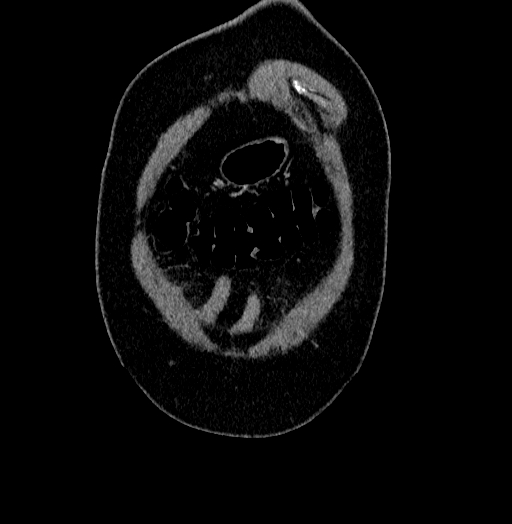 Acute appendicitis (Radiopaedia 79950-93224 Coronal C+ portal venous phase 2).jpg