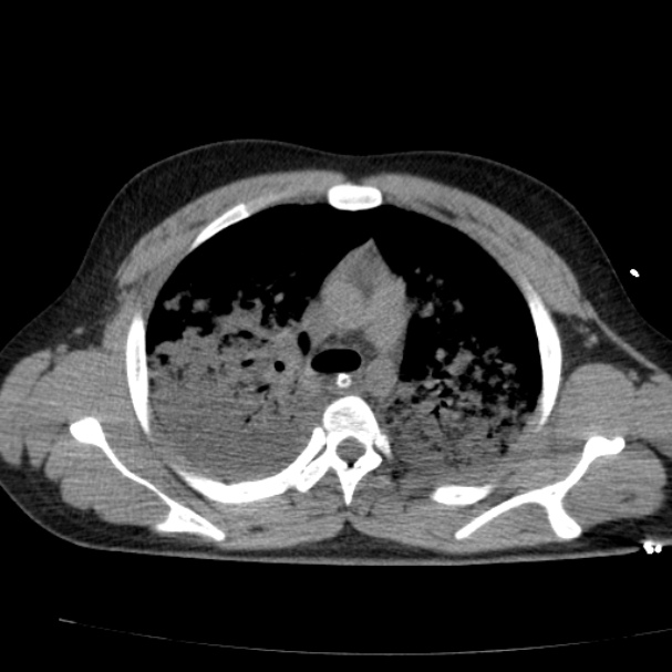 Acute aspiration pneumonitis (Radiopaedia 33605-34703 Axial non-contrast 37).jpg