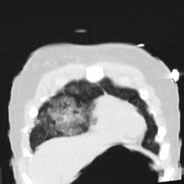 Acute aspiration pneumonitis (Radiopaedia 33605-34703 Coronal lung window 18).jpg