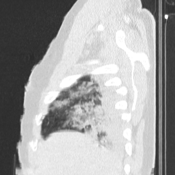 Acute aspiration pneumonitis (Radiopaedia 33605-34703 Sagittal lung window 16).jpg