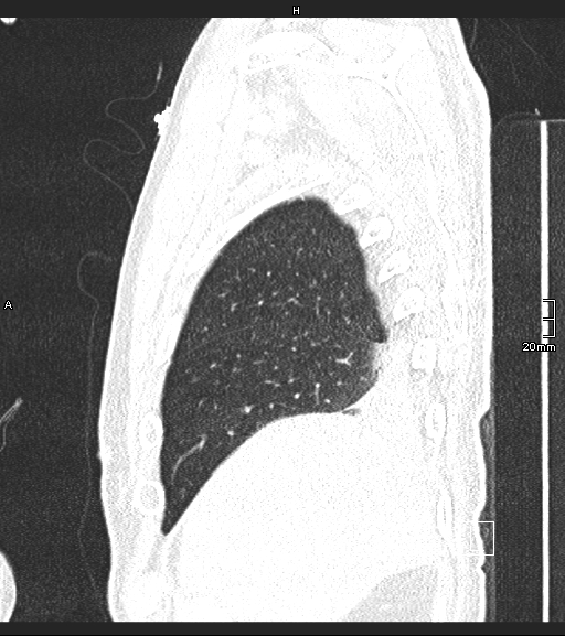 Acute aspiration pneumonitis (Radiopaedia 55642-62166 Sagittal lung window 134).jpg