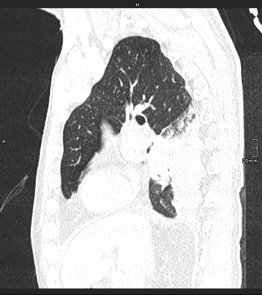Acute aspiration pneumonitis (Radiopaedia 55642-62166 Sagittal lung window 96).jpg