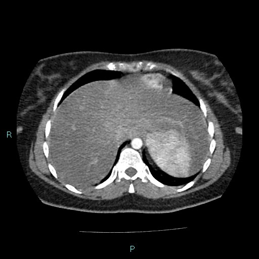Acute bilateral pyelonephritis (Radiopaedia 37146-38881 Axial C+ arterial phase 16).jpg