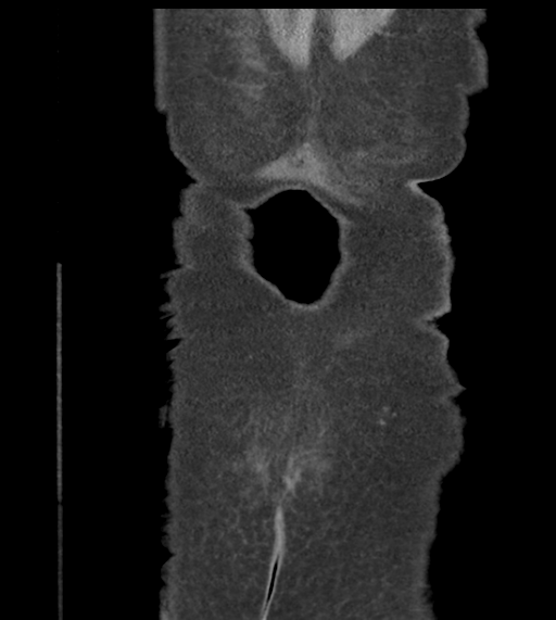 Acute bleed from gastric fundus biopsy site (Radiopaedia 35201-36737 D 56).png