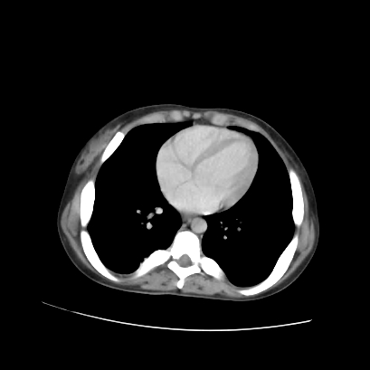 Acute calculous cholecystitis in patient with osteopetrosis (Radiopaedia 77871-90159 Axial C+ portal venous phase 10).jpg