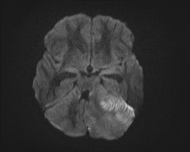 File:Acute cerebellar ataxia (Radiopaedia 61487-69446 Axial DWI 7).jpg