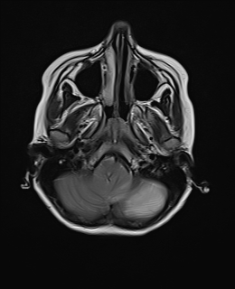 File:Acute cerebellar ataxia (Radiopaedia 61487-69446 Axial T2 3).jpg