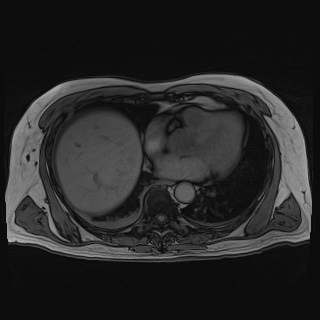 Acute cholecystitis (Radiopaedia 72392-82923 Axial T1 out-of-phase 15).jpg